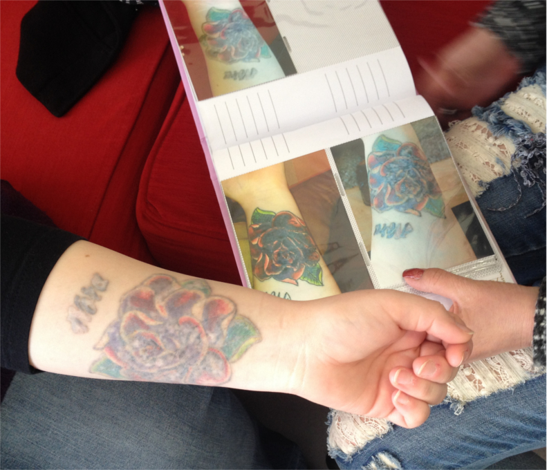 Tattooentfernung Dokumentation